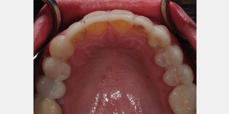 Carillas dentales: la filtración en los bordes puede avanzar sin que se vea